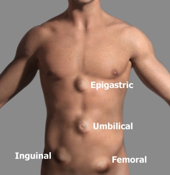 umbilical hernia in adults. after umbilical hernia