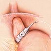 lapband surgery