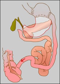 Biliopancreatic Diversion BPD