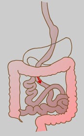 Gastric Bypass