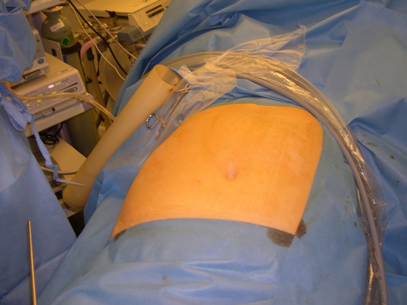 Cholecystitis Liverpool Single Incision Laparoscopic