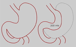 Tube Gastrectomy